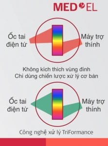 cấy ốc tai một bên, đeo máy trợ thính một bên